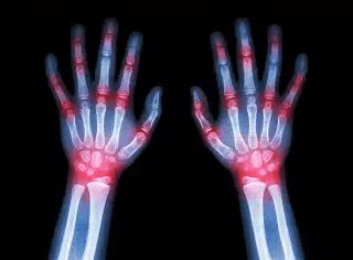 What’s New in Arthritis Pain Care This November in Southwest Florida